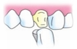 色形をまわりの歯と違和感のないように仕上げたセラミックを被せて完了です。