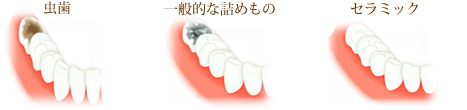 インレー